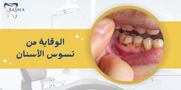 الوقاية من تسوس الأسنان