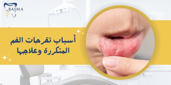 أسباب تقرحات الفم المتكررة وعلاجها