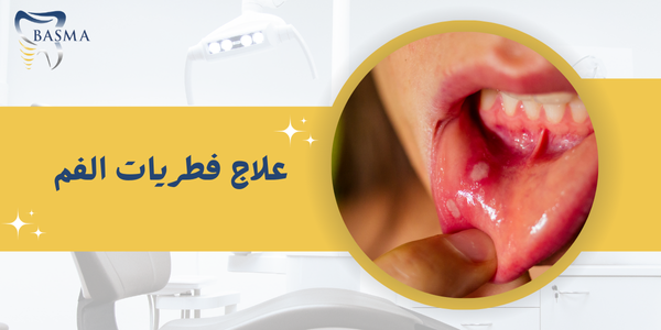 علاج فطريات الفم