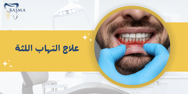 علاج التهاب اللثة